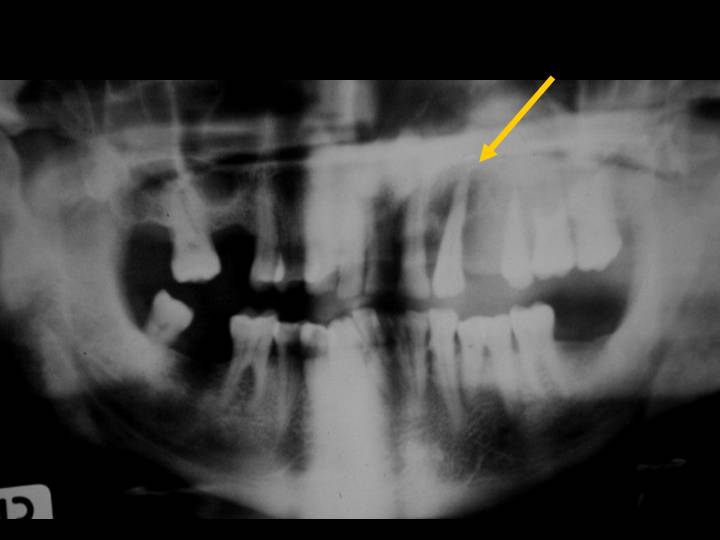 Carcinoma odontognico de celulas claras