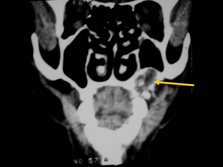 Carcinoma odontognico de celulas claras