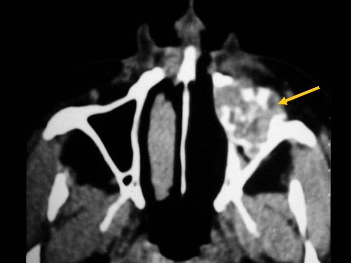 Carcinoma odontognico de celulas claras