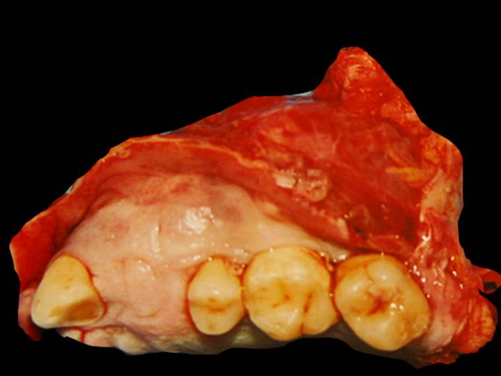 Carcinoma odontogénico de celulas claras