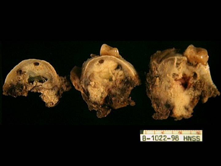 Carcinoma odontognico de celulas claras