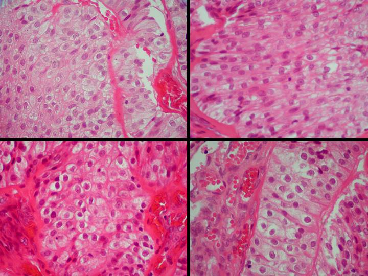 Carcinoma odontognico de celulas claras