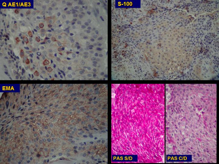 Carcinoma odontognico de celulas claras